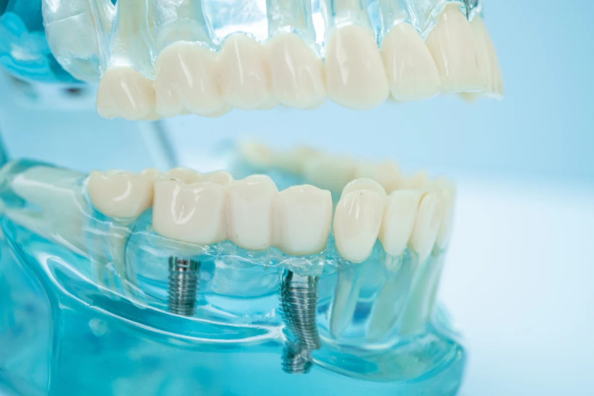 Chirurgia orale - Studio Dentistico Green Smile